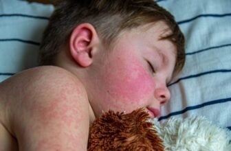 Measles Outbreaks In The U.S. Highlight The Import...