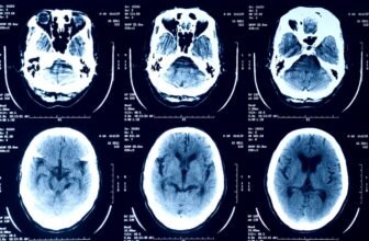 Episource is notifying millions of people that the...